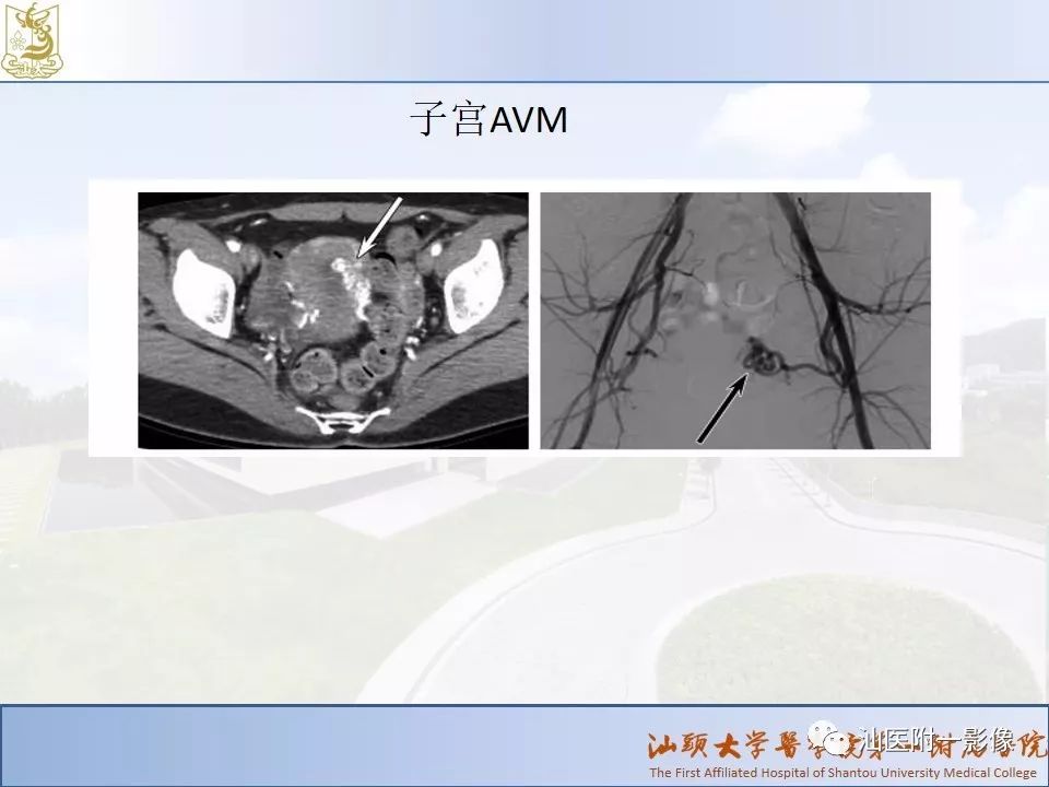 影像PPT - 【PPT】妇科急腹症的CT和MRI诊断-31