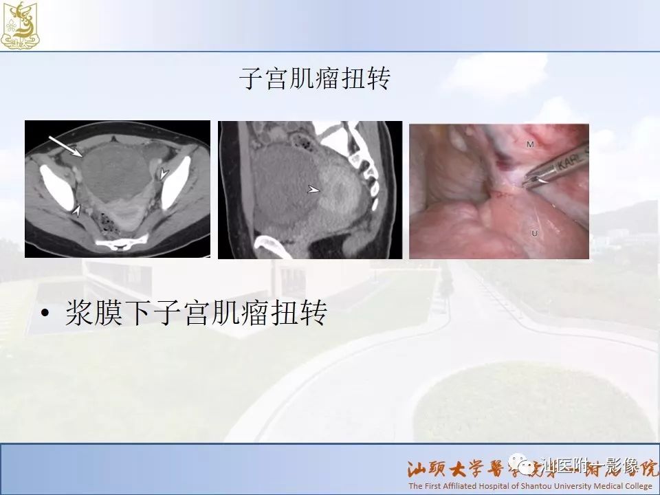 影像PPT - 【PPT】妇科急腹症的CT和MRI诊断-30