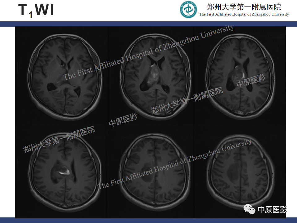影像PPT - 【病例】侧脑室胶质母细胞瘤1例MR影像-3