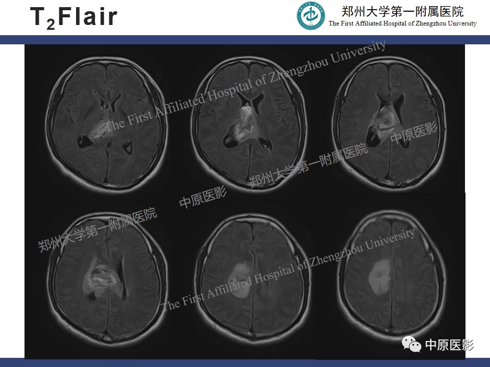 影像PPT - 【病例】侧脑室胶质母细胞瘤1例MR影像-5
