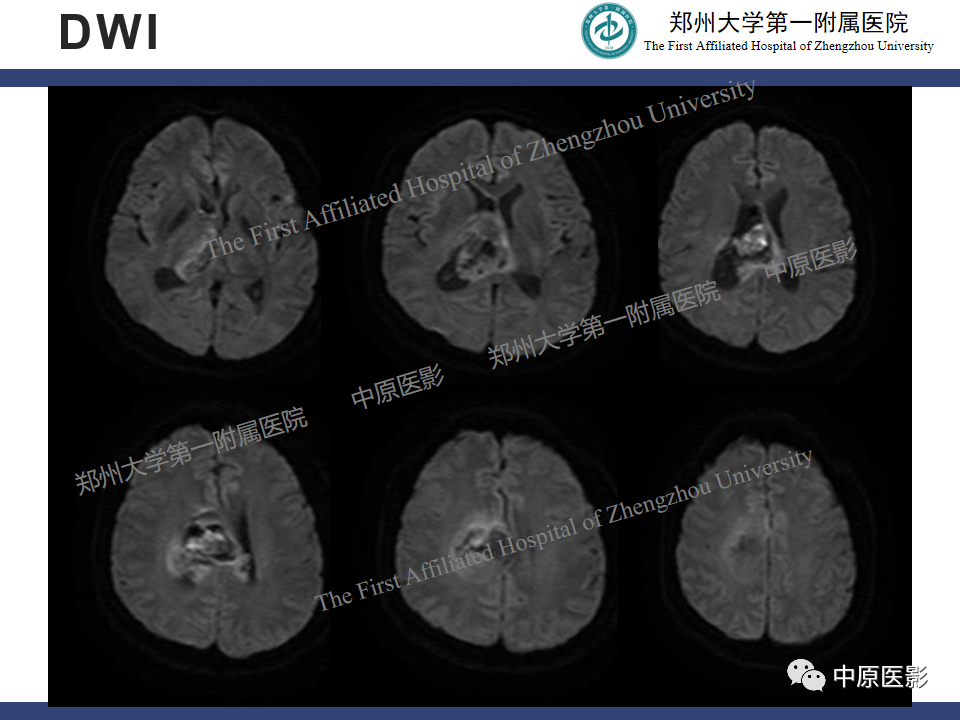 影像PPT - 【病例】侧脑室胶质母细胞瘤1例MR影像-6