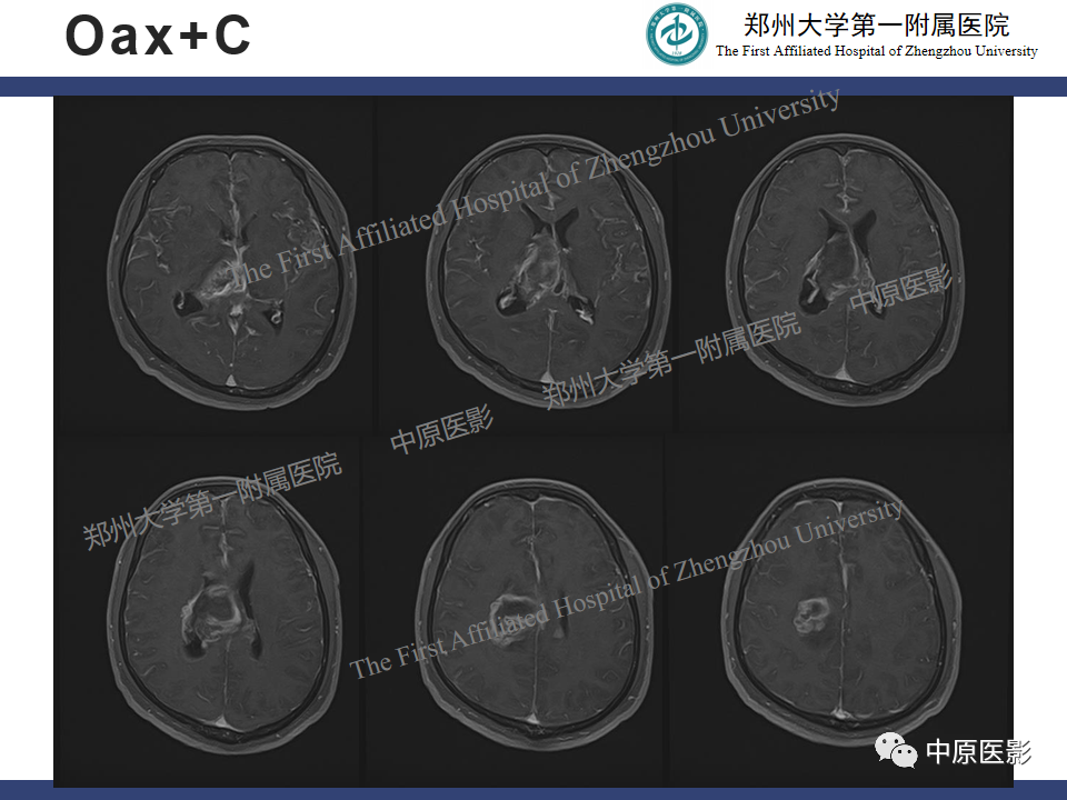 影像PPT - 【病例】侧脑室胶质母细胞瘤1例MR影像-7