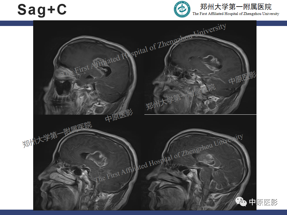 影像PPT - 【病例】侧脑室胶质母细胞瘤1例MR影像-8