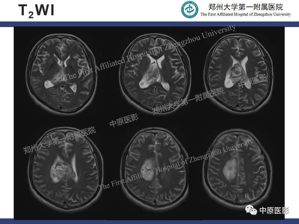 影像PPT - 【病例】侧脑室胶质母细胞瘤1例MR影像-4