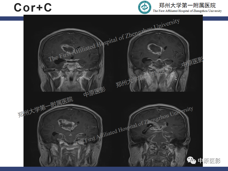 影像PPT - 【病例】侧脑室胶质母细胞瘤1例MR影像-9