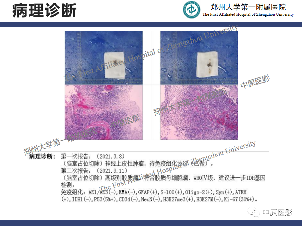 影像PPT - 【病例】侧脑室胶质母细胞瘤1例MR影像-12