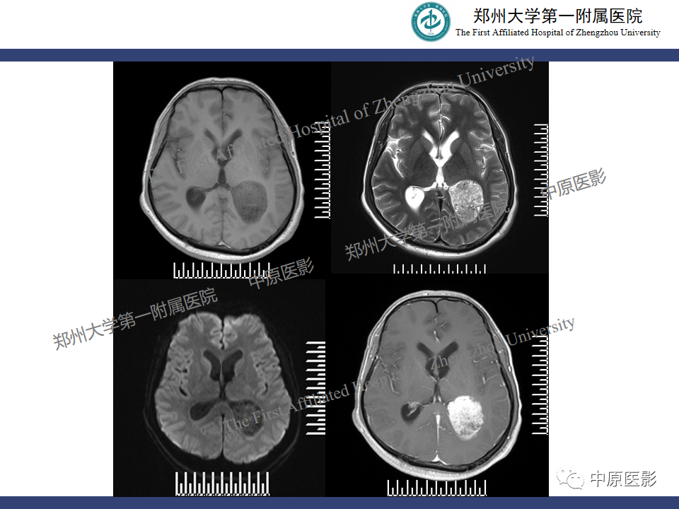 影像PPT - 【病例】侧脑室胶质母细胞瘤1例MR影像-17