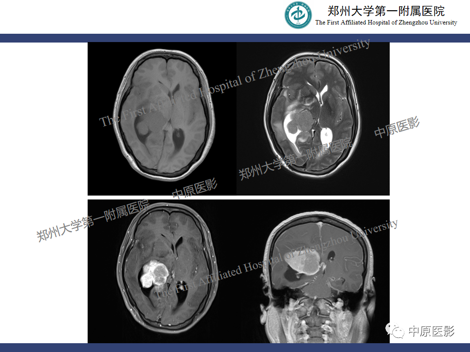 影像PPT - 【病例】侧脑室胶质母细胞瘤1例MR影像-19