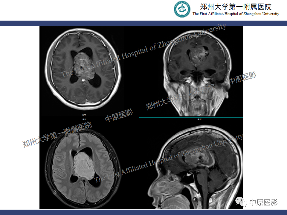 影像PPT - 【病例】侧脑室胶质母细胞瘤1例MR影像-23