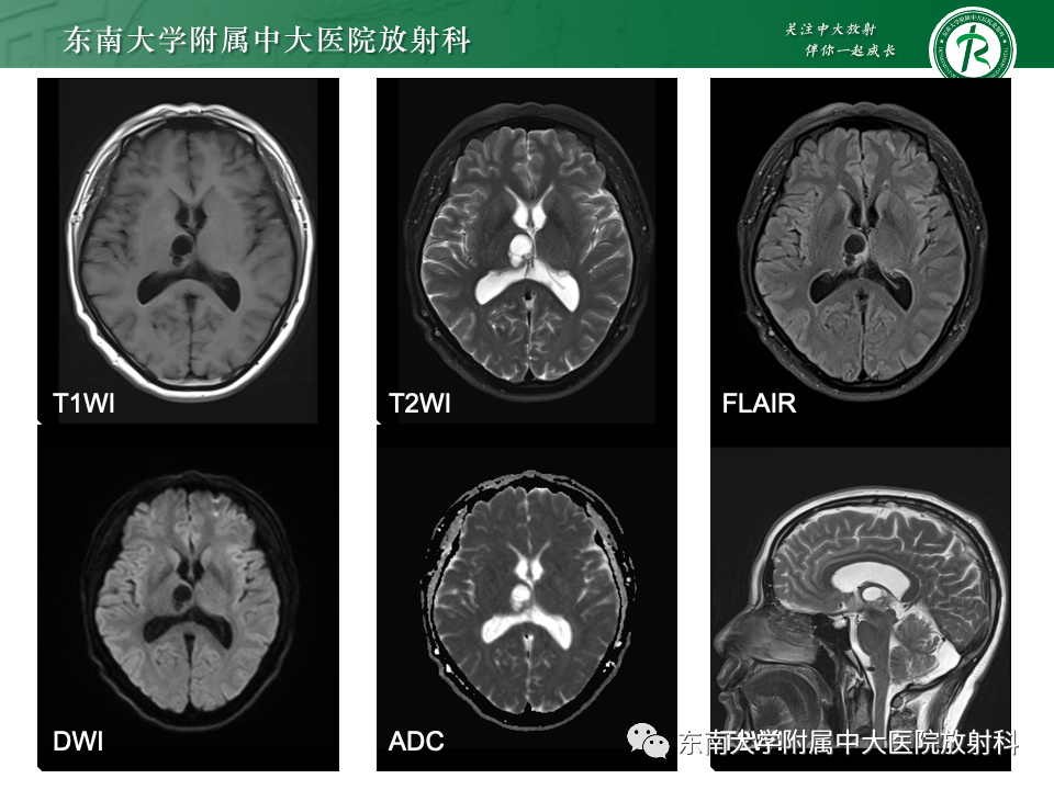 影像PPT - 【PPT】颅内常见囊性病变诊断-3