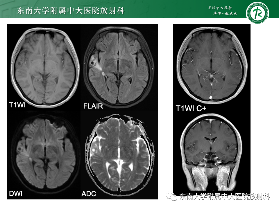 影像PPT - 【PPT】颅内常见囊性病变诊断-6