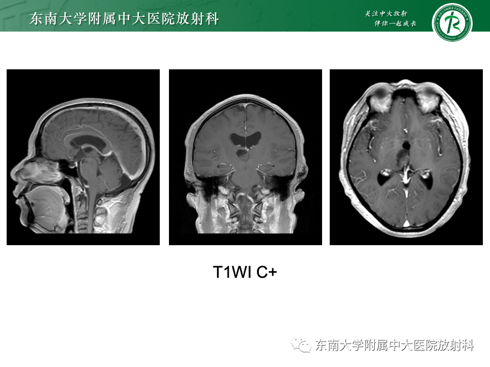 影像PPT - 【PPT】颅内常见囊性病变诊断-4