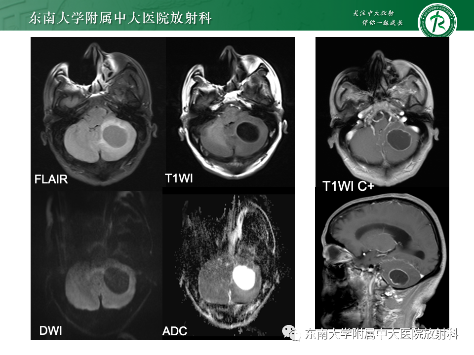 影像PPT - 【PPT】颅内常见囊性病变诊断-8