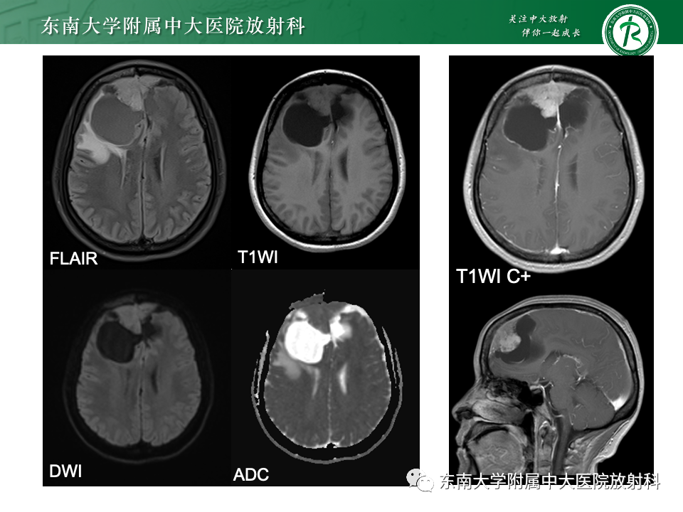 影像PPT - 【PPT】颅内常见囊性病变诊断-10