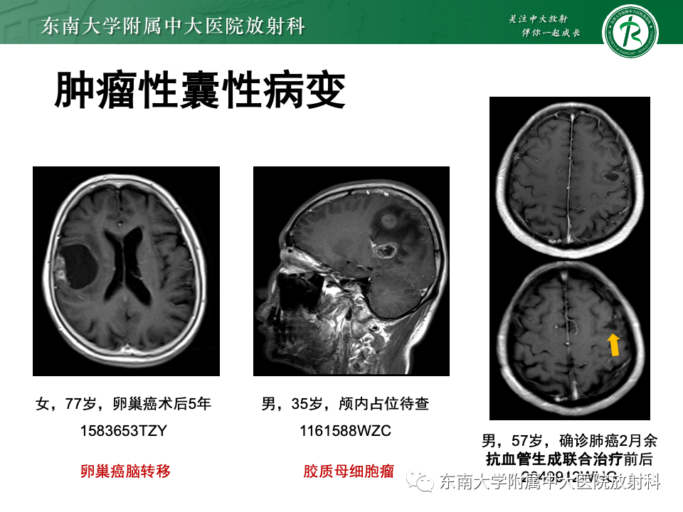 影像PPT - 【PPT】颅内常见囊性病变诊断-27