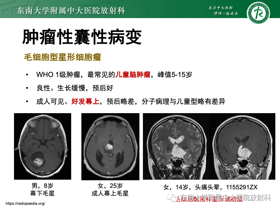影像PPT - 【PPT】颅内常见囊性病变诊断-32
