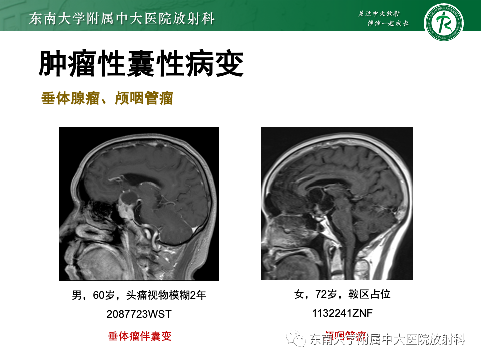 影像PPT - 【PPT】颅内常见囊性病变诊断-36