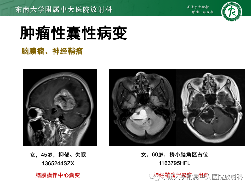 影像PPT - 【PPT】颅内常见囊性病变诊断-34