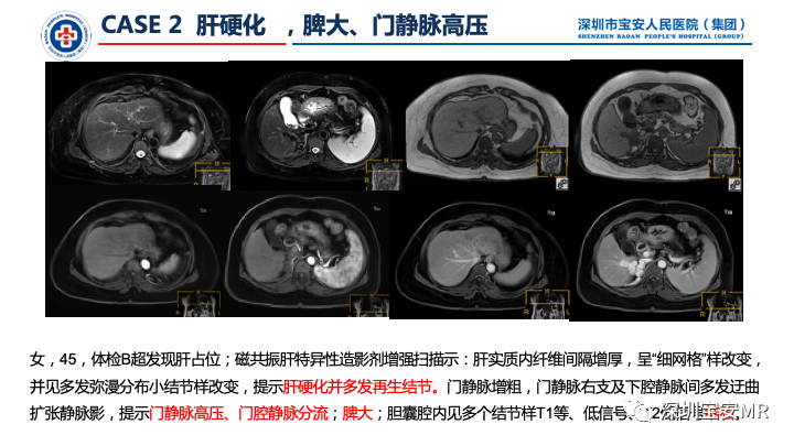 影像PPT - 【PPT】上腹部磁共振检查-8