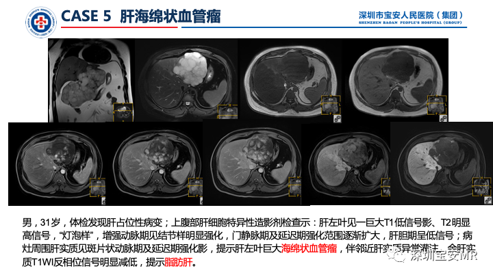 影像PPT - 【PPT】上腹部磁共振检查-11