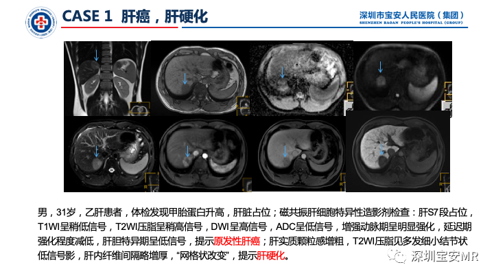 影像PPT - 【PPT】上腹部磁共振检查-7