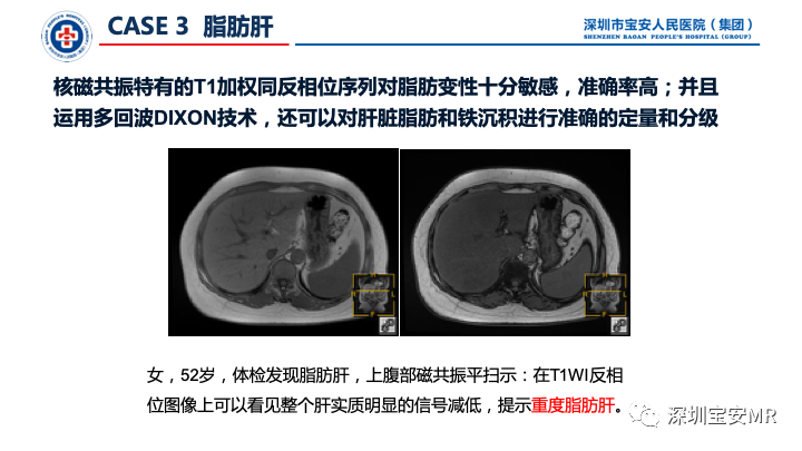 影像PPT - 【PPT】上腹部磁共振检查-9