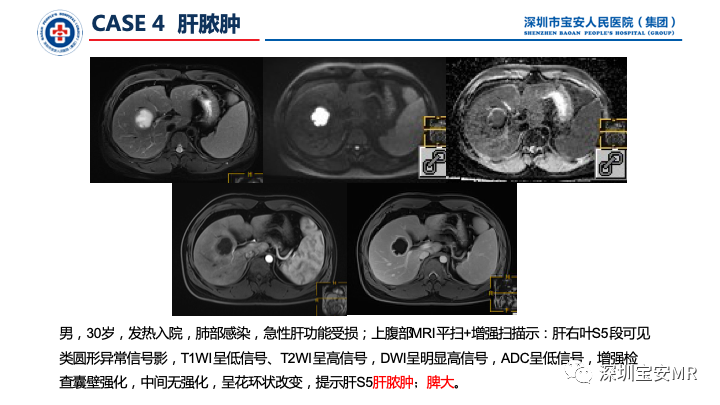 影像PPT - 【PPT】上腹部磁共振检查-10