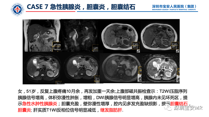 影像PPT - 【PPT】上腹部磁共振检查-13