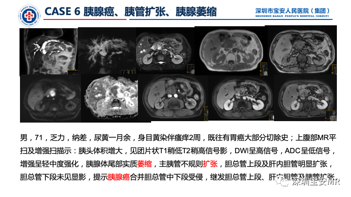影像PPT - 【PPT】上腹部磁共振检查-12