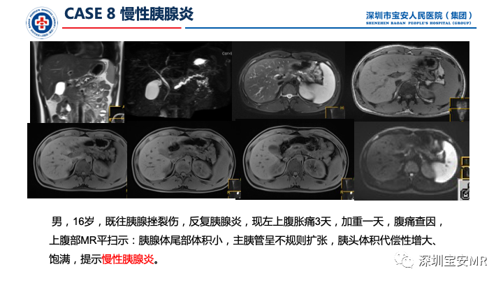 影像PPT - 【PPT】上腹部磁共振检查-14