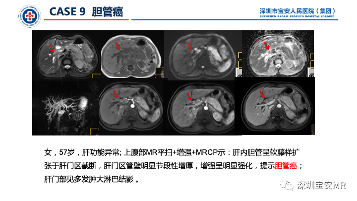 影像PPT - 【PPT】上腹部磁共振检查-15
