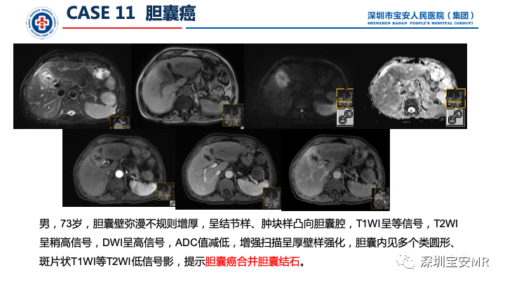 影像PPT - 【PPT】上腹部磁共振检查-17