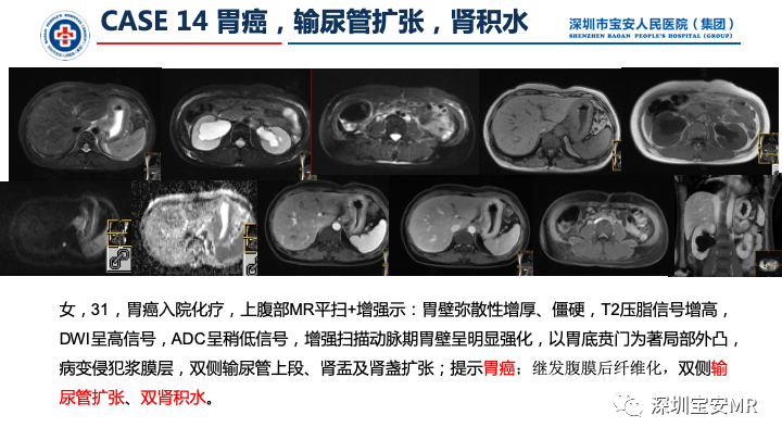 影像PPT - 【PPT】上腹部磁共振检查-20