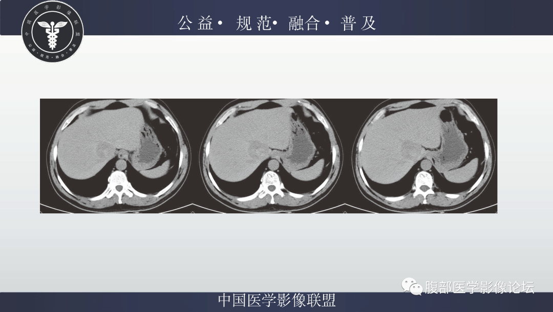 影像PPT - 【病例】肝脏上皮样血管平滑肌脂肪瘤1例影像诊断-3