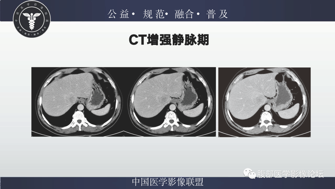 影像PPT - 【病例】肝脏上皮样血管平滑肌脂肪瘤1例影像诊断-5