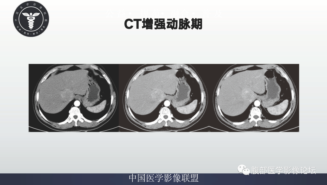 影像PPT - 【病例】肝脏上皮样血管平滑肌脂肪瘤1例影像诊断-4
