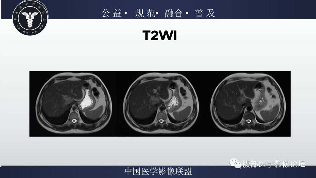 影像PPT - 【病例】肝脏上皮样血管平滑肌脂肪瘤1例影像诊断-7