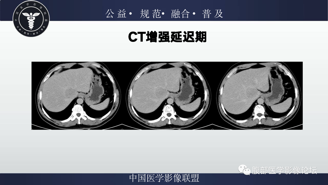 影像PPT - 【病例】肝脏上皮样血管平滑肌脂肪瘤1例影像诊断-6