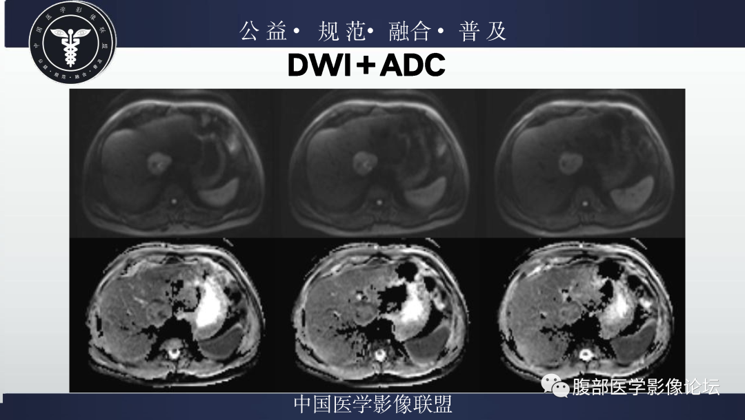影像PPT - 【病例】肝脏上皮样血管平滑肌脂肪瘤1例影像诊断-8