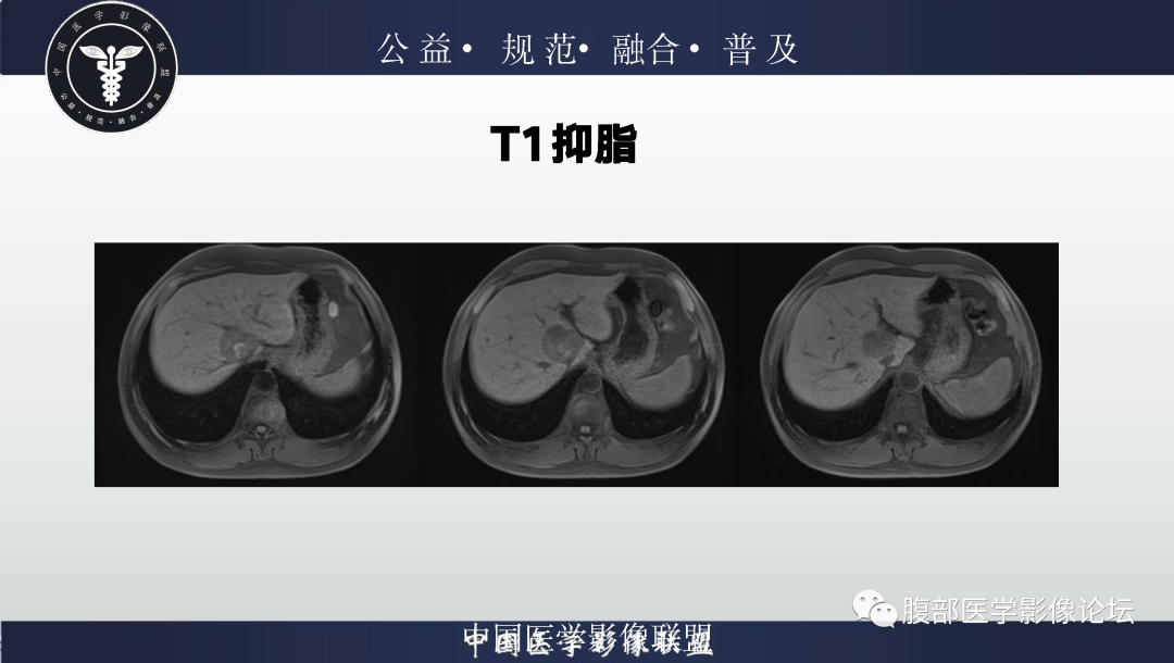 影像PPT - 【病例】肝脏上皮样血管平滑肌脂肪瘤1例影像诊断-10