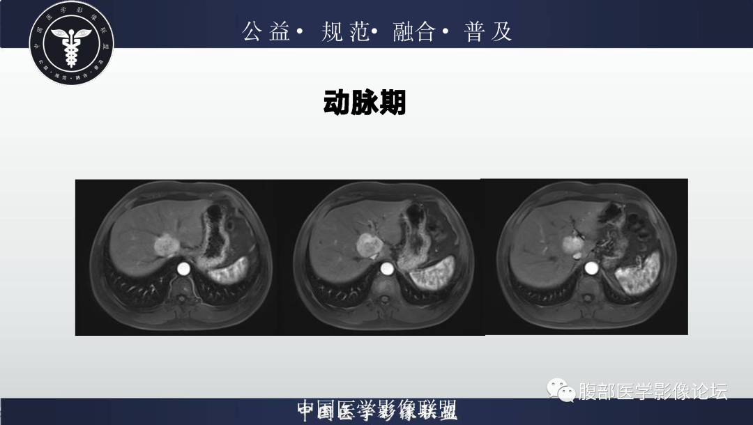 影像PPT - 【病例】肝脏上皮样血管平滑肌脂肪瘤1例影像诊断-11