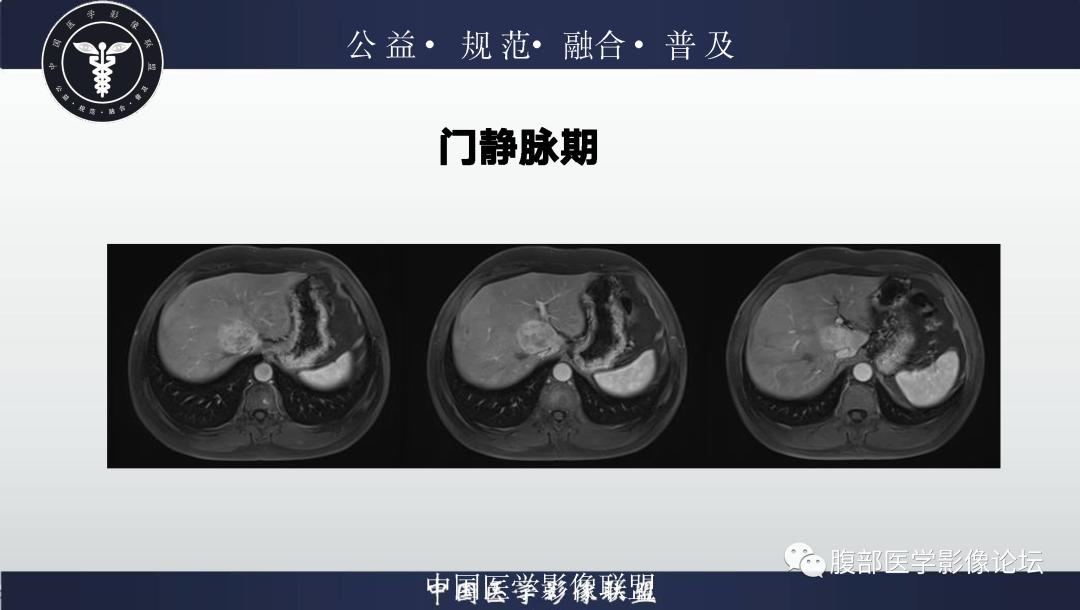 影像PPT - 【病例】肝脏上皮样血管平滑肌脂肪瘤1例影像诊断-12