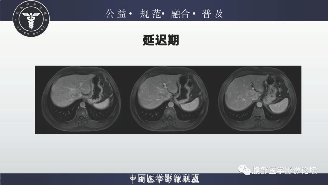 影像PPT - 【病例】肝脏上皮样血管平滑肌脂肪瘤1例影像诊断-13