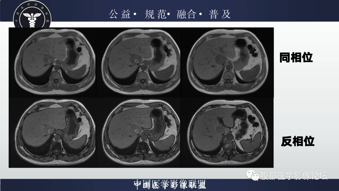 影像PPT - 【病例】肝脏上皮样血管平滑肌脂肪瘤1例影像诊断-9