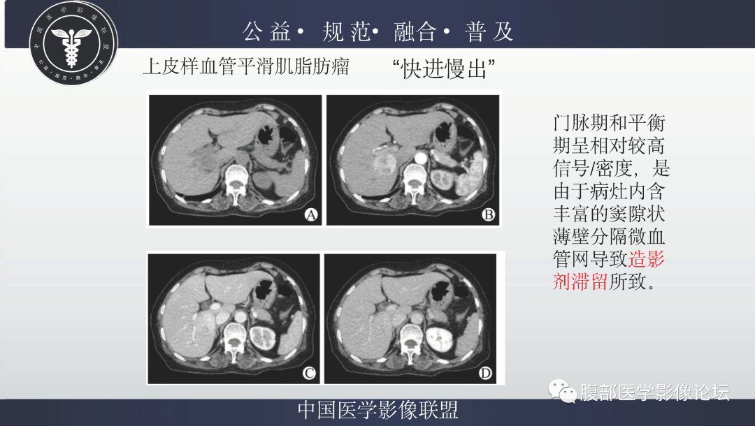 影像PPT - 【病例】肝脏上皮样血管平滑肌脂肪瘤1例影像诊断-22