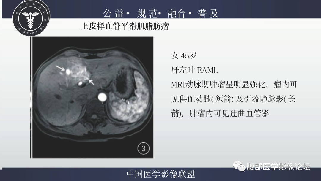 影像PPT - 【病例】肝脏上皮样血管平滑肌脂肪瘤1例影像诊断-24