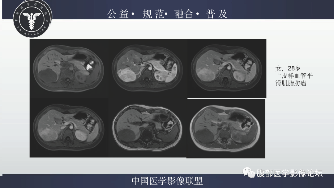 影像PPT - 【病例】肝脏上皮样血管平滑肌脂肪瘤1例影像诊断-25