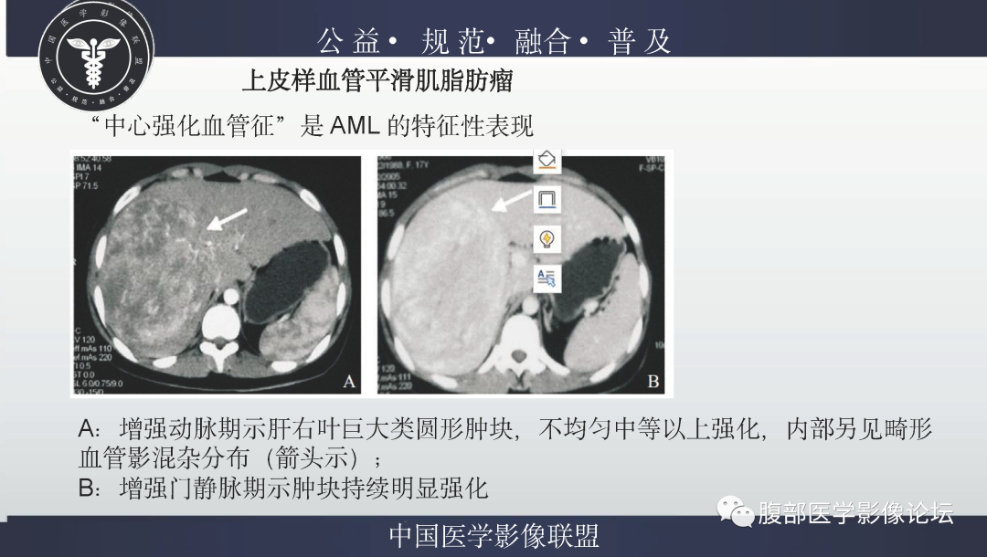 影像PPT - 【病例】肝脏上皮样血管平滑肌脂肪瘤1例影像诊断-23