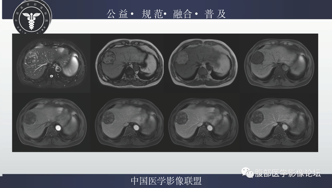 影像PPT - 【病例】肝脏上皮样血管平滑肌脂肪瘤1例影像诊断-26
