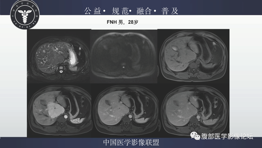 影像PPT - 【病例】肝脏上皮样血管平滑肌脂肪瘤1例影像诊断-30